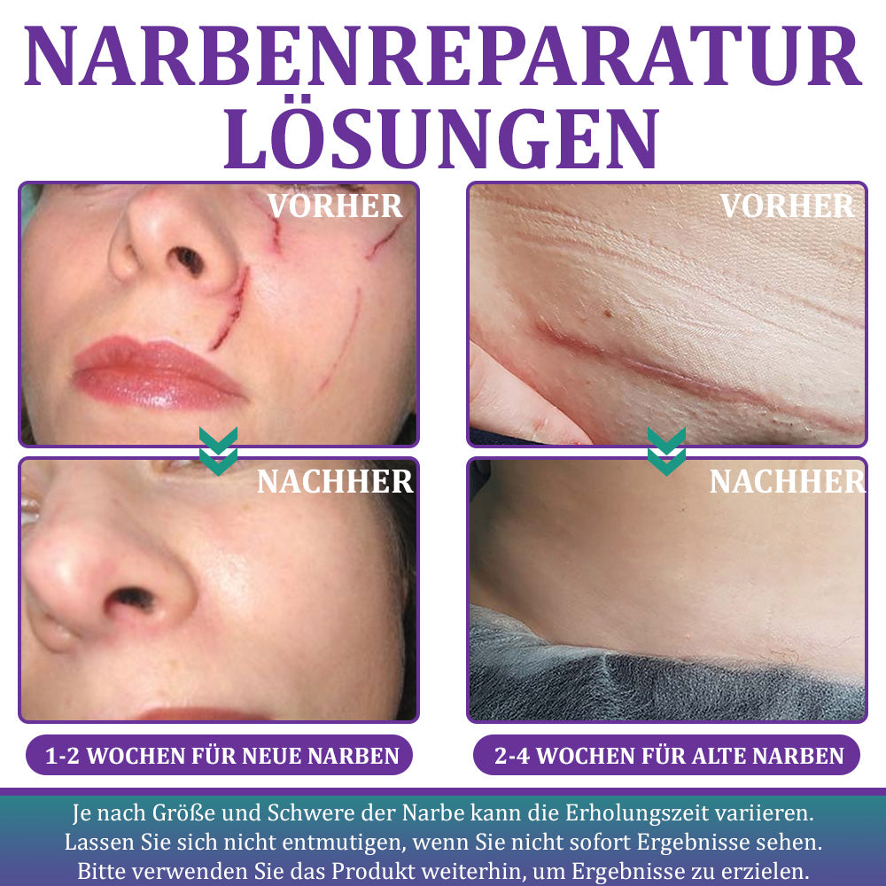🌼Offizieller Shop🏷️: Flysmus® ReGen Hyaluronsäure Nano-Heal Mikronadel-Pflaster – 💝Behandlung von alten und neuen Narben, Reduktion von Operationsnarben, Dehnungsstreifen, Keloiden, Akne, Verbrennungen, Warzen, Hautveränderungen und Krampfadern