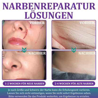 🌼Offizieller Shop🏷️: Flysmus® ReGen Hyaluronsäure Nano-Heal Mikronadel-Pflaster – 💝Behandlung von alten und neuen Narben, Reduktion von Operationsnarben, Dehnungsstreifen, Keloiden, Akne, Verbrennungen, Warzen, Hautveränderungen und Krampfadern
